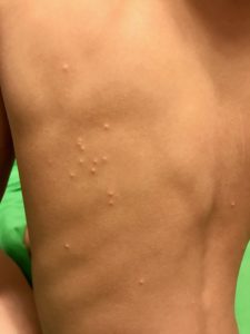 What Are Signs Of The Skin Virus Molluscum Contagiosum Molluscumrx