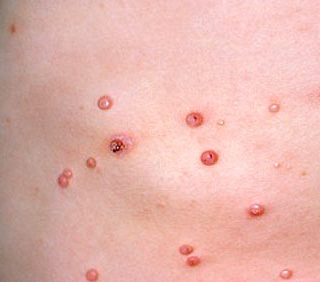Your Questions Answered: Is Molluscum Contagiosum an STD 