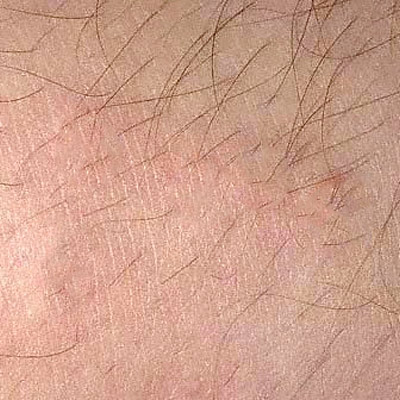 Molluscum Contagiosum After Treatment What is molluscum contagiosum 