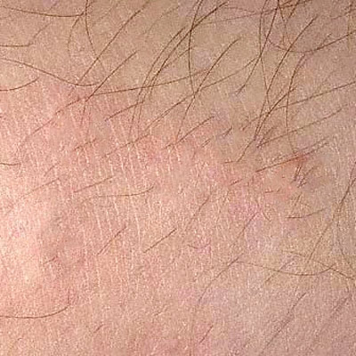 Molluscum Contagiosum Pictures And Symptoms