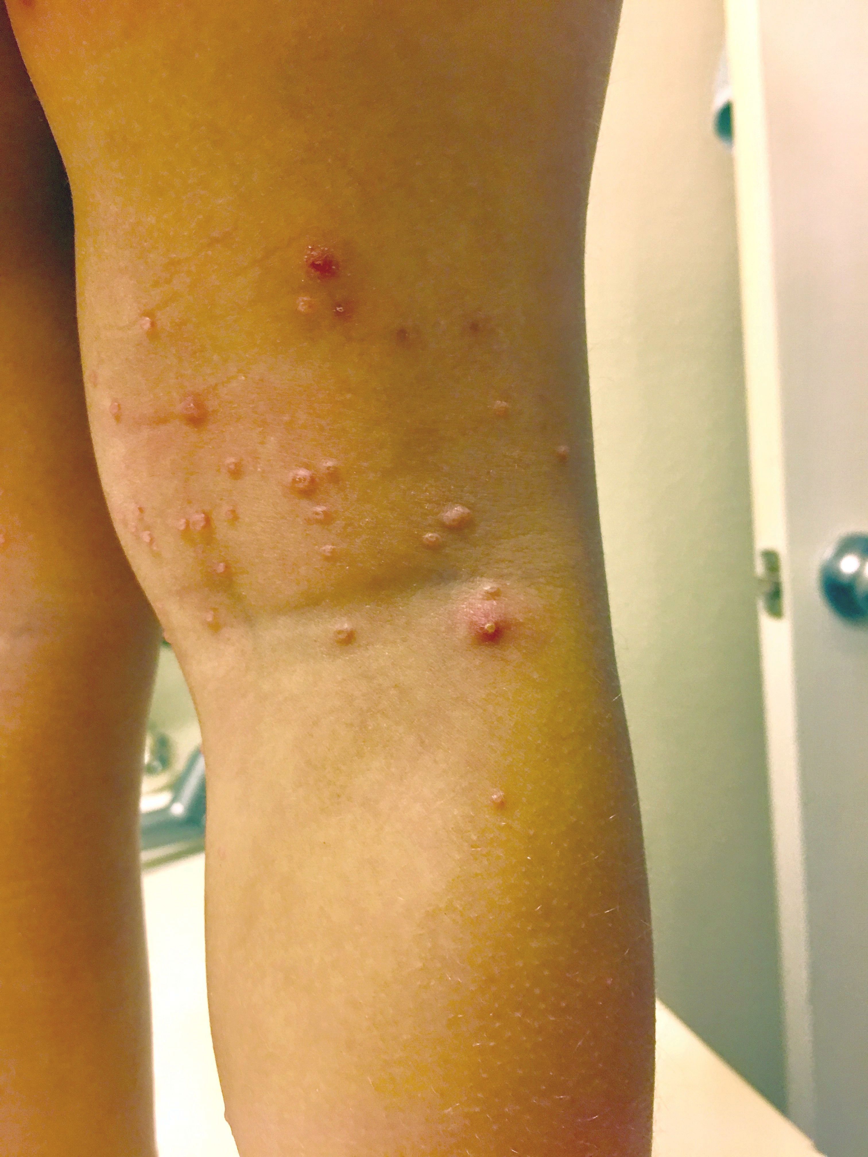 clear-bumps-on-legs