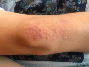 knee eczema
